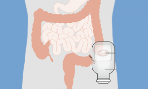 Colostomía